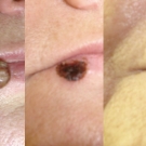 Efekty zabiegów laserem CO2