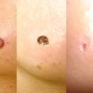 Efekty zabiegów laserem CO2