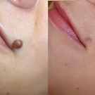 Efekty zabiegów laserem CO2