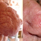 Efekty zabiegów laserem CO2