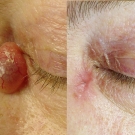 Efekty zabiegów laserem CO2