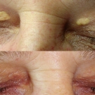 Efekty zabiegów laserem CO2