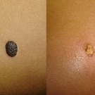 Efekty zabiegów laserem CO2