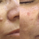 Efekty zabiegów laserem CO2