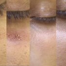 Efekty zabiegów laserem CO2