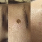 Efekty zabiegów laserem CO2