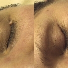 Efekty zabiegów laserem CO2