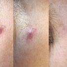 Efekty zabiegów laserem CO2