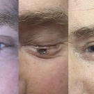 Efekty zabiegów laserem CO2