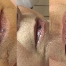 Efekty zabiegów laserem CO2