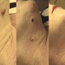 Efekty zabiegów laserem CO2