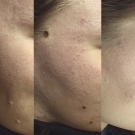 Efekty zabiegów laserem CO2