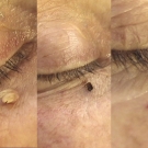 Efekty zabiegów laserem CO2