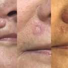 Efekty zabiegów laserem CO2