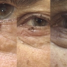 Efekty zabiegów laserem CO2