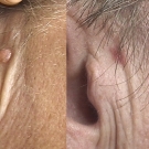 Efekty zabiegów laserem CO2