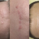 Efekty zabiegów laserem CO2